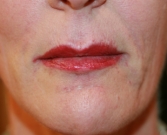 Feel Beautiful - Lip Creases Lip Lines and Slight Lip Augmentation - After Photo